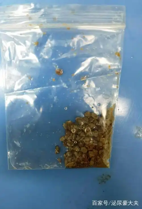 尿酸结石做了微创手术,就一劳永逸了吗_痛风_治疗方式_日常注意事项 -