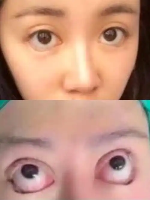 "反人类结构"手术:眼睑下至,后遗症居然这么多?