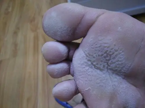 脚底板经常这样,见图,平时穿鞋脚汗大,半天或者稍微热水泡脚五分钟就