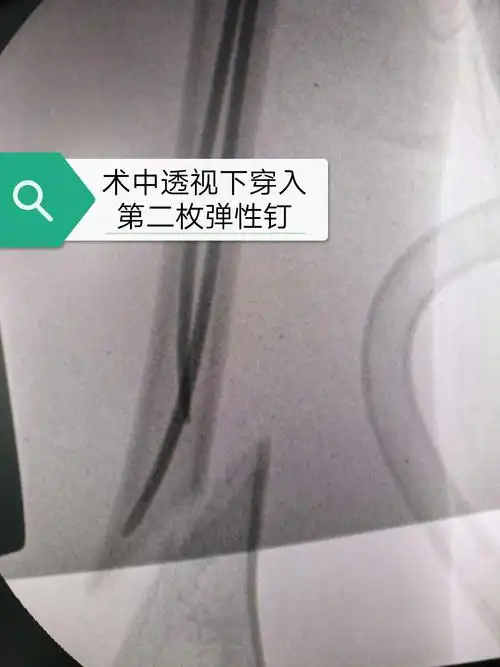 固镇博爱医院 骨科 分享二例儿童骨折闭合复位钛制弹性髓内钉(ten)内