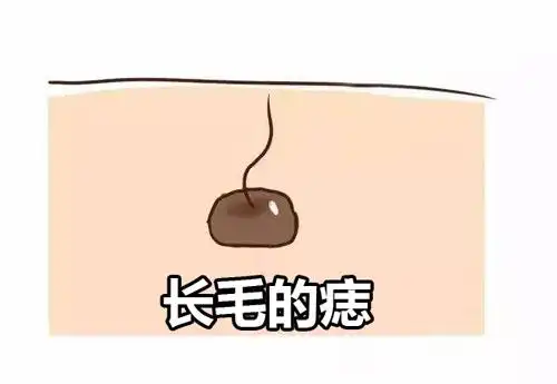 痣上长毛代表有福气 十分的有福气