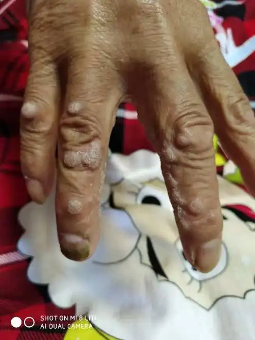 请问这是是什么皮肤病,有见过的吗?家里的老人