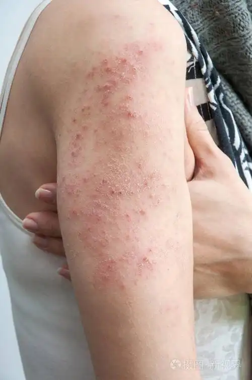 过敏性皮疹皮炎不同类型的过敏性皮炎症状图片3过敏性皮炎发生的原因