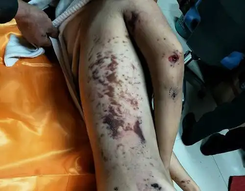 济南一女大学生校内裸体坠亡 尸体满是伤痕淤青