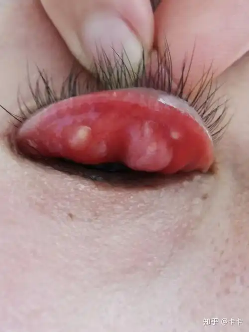 眼睛霰粒肿手术的一天