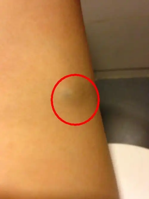 胳膊处血管脂肪瘤图片