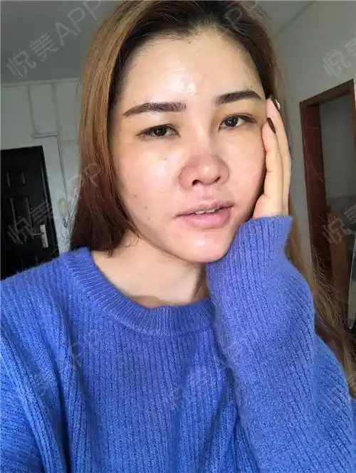 自体脂肪面部填充术后4天_面部填充术后4天_自体脂肪术后4天_面部轮廓