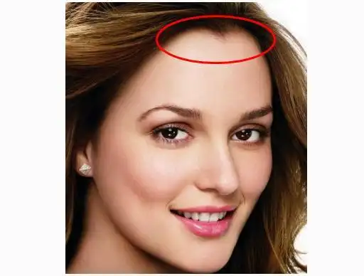 美人尖倒着长可就会导致发际线过高的问题了,整体颜值可就会下降采儋