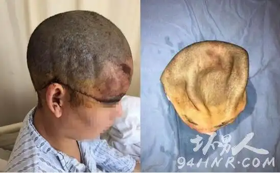 女子整张头皮被撕图片