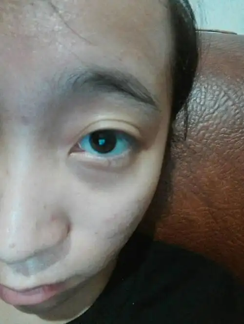 我的是黑眼圈还是眼袋,我近视戴眼镜的,该怎么消除淡化