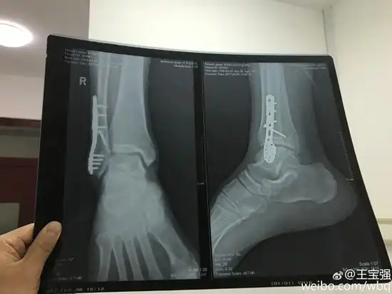 王宝强脚打钢板拍两年电影今天终于取出