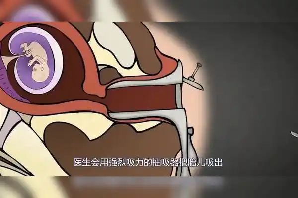 人流是怎样打掉孩子的3d动画演示全程看完痛心疾首
