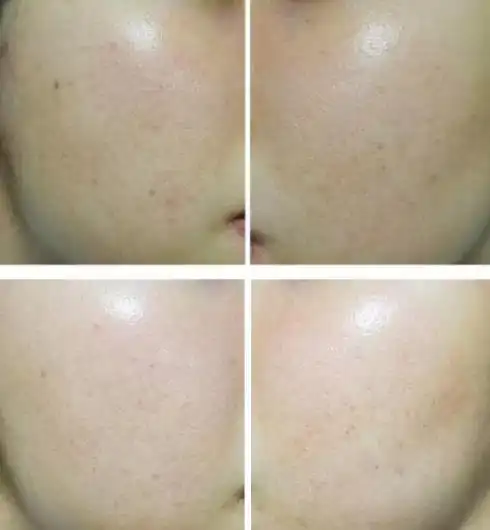 韩国美白针注射后对比效果好吗