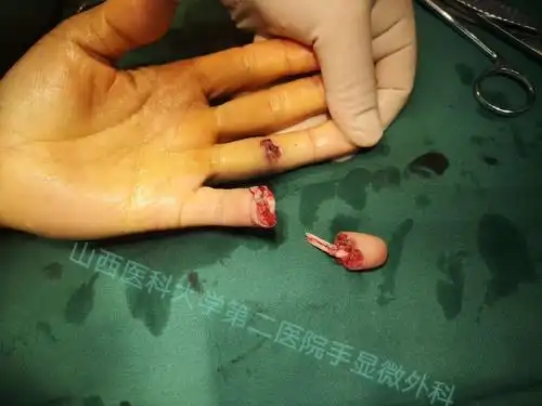 山医大二院显微外科之断指篇