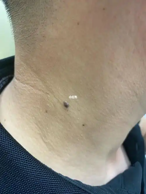 脖子瘊子长了几十年需要祛吗