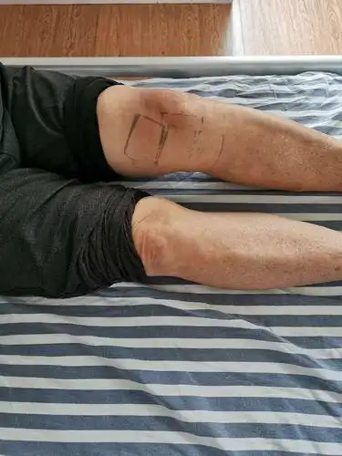 樟树市清江医院疼痛科超声可视化下膝关节炎的治疗