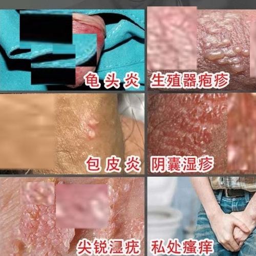 生殖男器疱疹清根除抑菌喷剂性病克星一扫光疱疹断根肉粒带状药膏