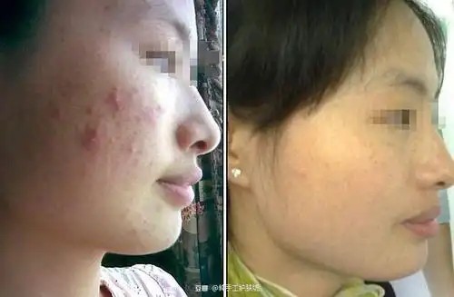 《惠儿痘记》祛痘前后对比图