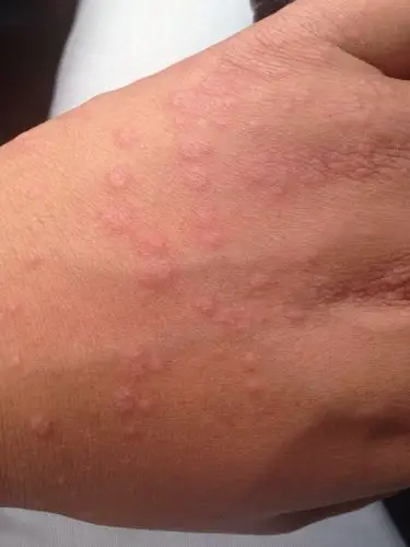 4 2010-01-03 高蛋白过敏症状 107 2012-04-08 高蛋白过敏 1 2009022