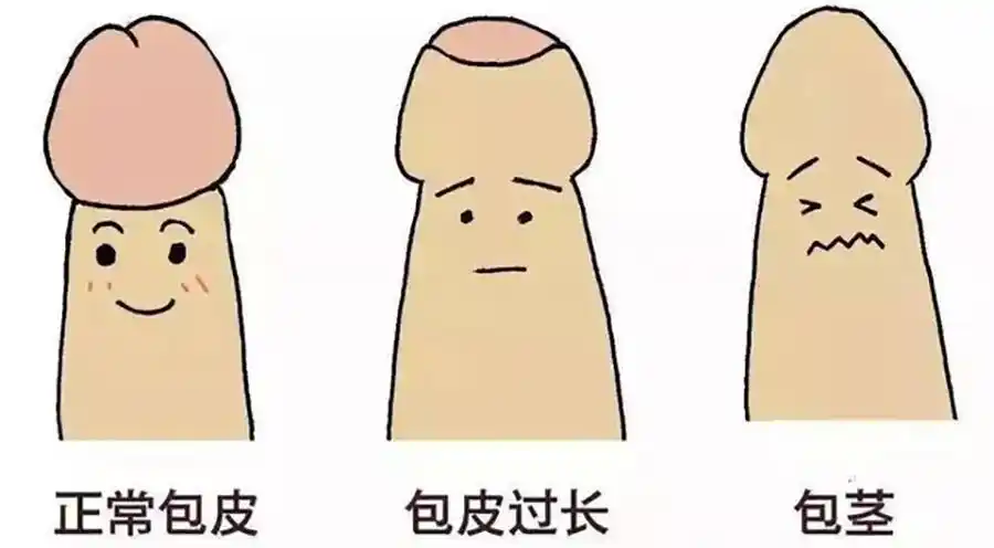 小儿包茎最佳手术时间是这个年龄