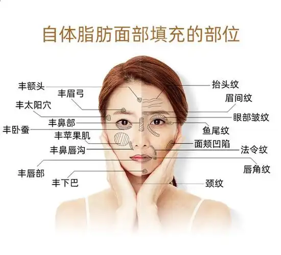 【自体脂肪面部填充】全脸填充 ,(张红芳纯化脂肪填充面部)14项专利