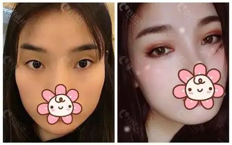 80%的人割了双眼皮后悔了?看完这两家术后效果才明白原因