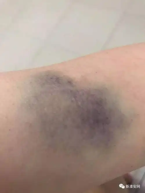 死者生前被打淤青照片流出.淮安26岁妈妈携儿喝农药身亡这事不简单