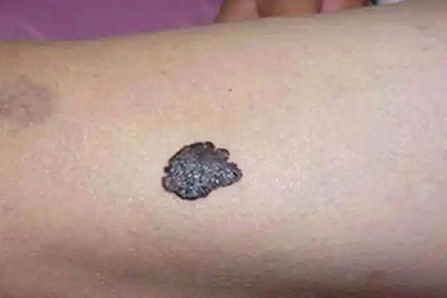 癌症潜伏时,身体会有这14种表现!中两条以上,就要当心了!