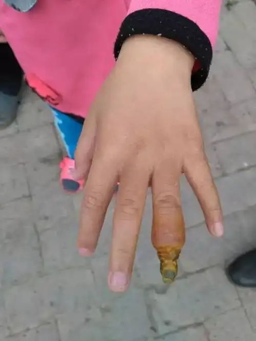 痛心河北5岁女孩手指面临截肢只因往手上套了这么一个东西家长一定要