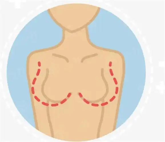 比如说外扩,下垂,收副乳的情况-生活美容-灵伊网