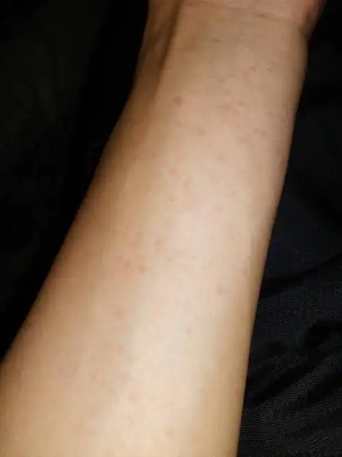 展开全部 病情分析: 这个和水温调解不当以及沐浴露等的刺激皮肤有