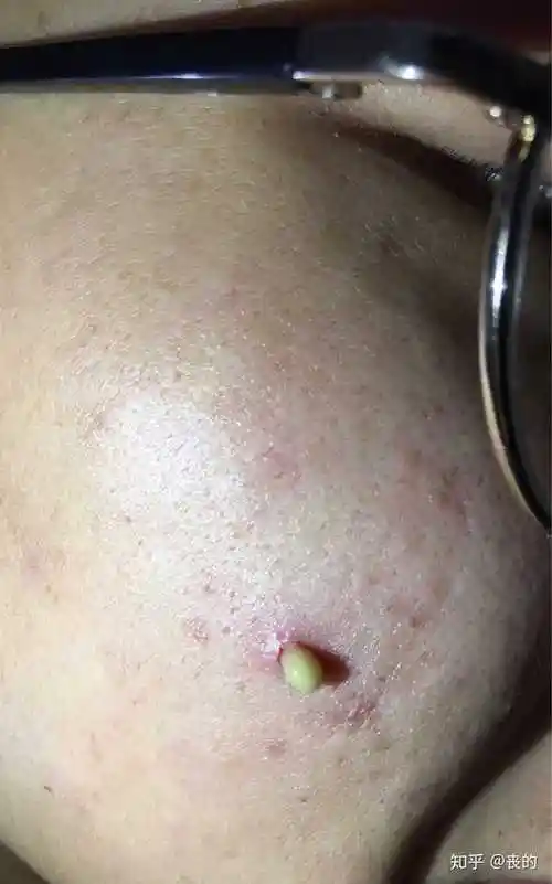 黑头大到直接挤出来是什么感受? - 知乎