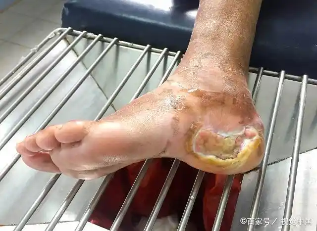 糖尿病患者并发足部溃烂,现在有感染流脓,还能治好吗?