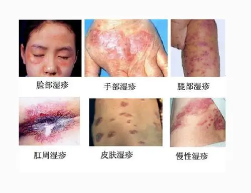 婴儿肛周湿疹图片_有来医生