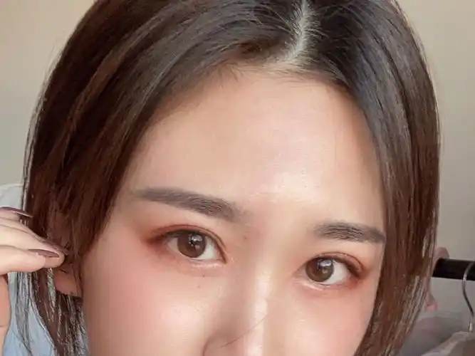 没想到双眼皮效果这么好,让单眼皮的我增大了好多,太_圈子-新氧美容