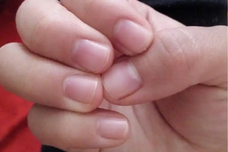 正常指甲正常指甲通常呈透明状,表面红润有光泽,甲板均匀表面光滑,没