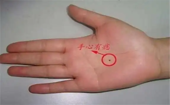 关于掌心痣的凄美传说,你得知道-996手相网
