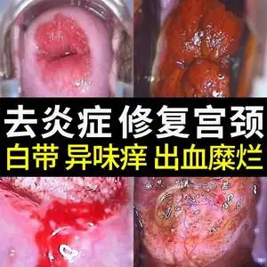 治疗妇科炎症滴虫图片