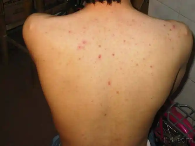 长春肤康医院浅谈:毛囊炎有哪些治疗方法?_局部_发病_皮肤