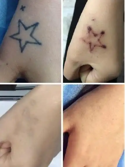 款洗纹身的效果图对比(4/9)