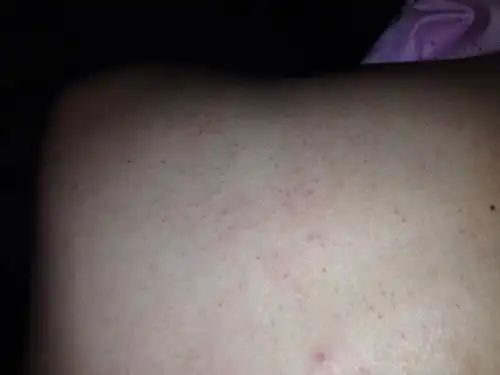 后背上有许多类似于黑头的小点,可以挤出黑色的东西,是什么症状.求解.