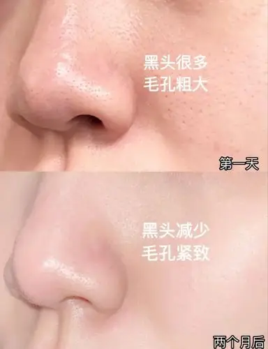 不到40块钱的清洁凝胶,搓一搓,角质,黑头,粉刺全带走!