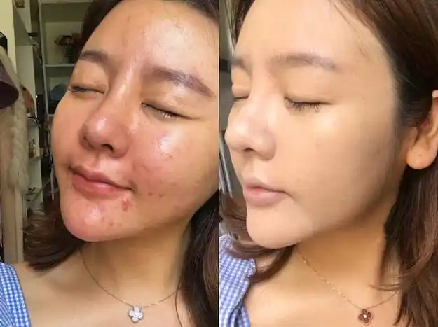 爱出油!毛孔大!痘痘!这样的皮.