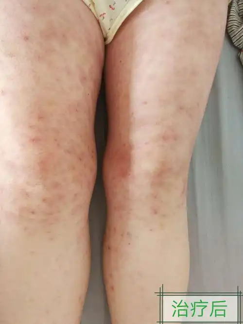 多形红斑型药疹诊治1例