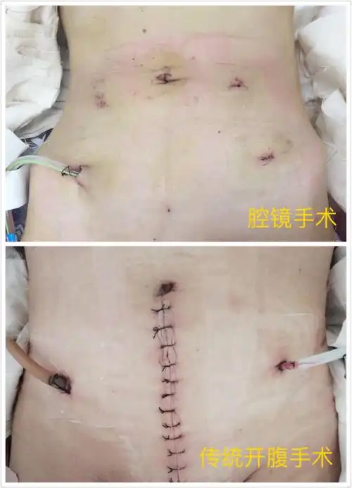 腹腔镜直肠癌根治手术与传统开腹手术相比有很多优点:1)全腹腔镜手术