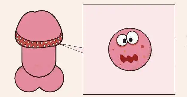 泉州男性龟头长一圈小颗粒(图1)