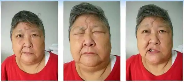 在临床上,周围性面瘫的患者症状呈现的很严重,对患者的工作和生活困扰