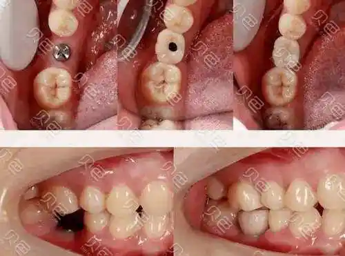 微创无痛种植牙真的不痛吗?分享做微创无痛种植的痛苦经历 - 贝色口腔