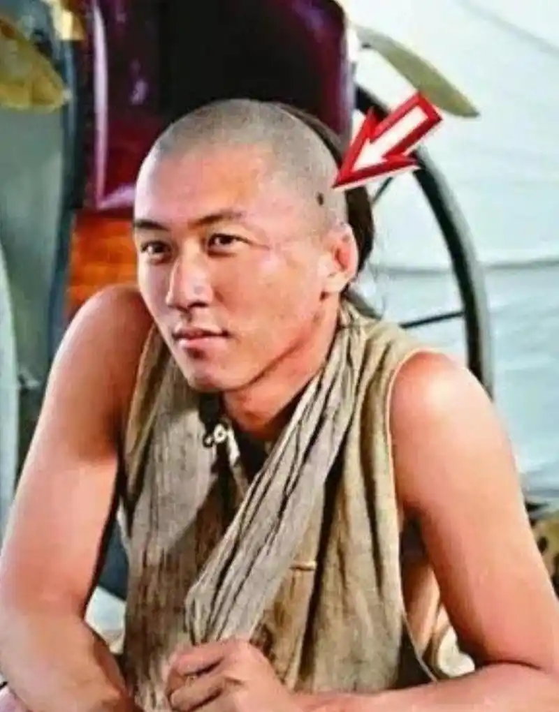 谢霆锋# 因拍戏需要剃光头意外发现头上的痣,确诊了早期皮肤癌继而