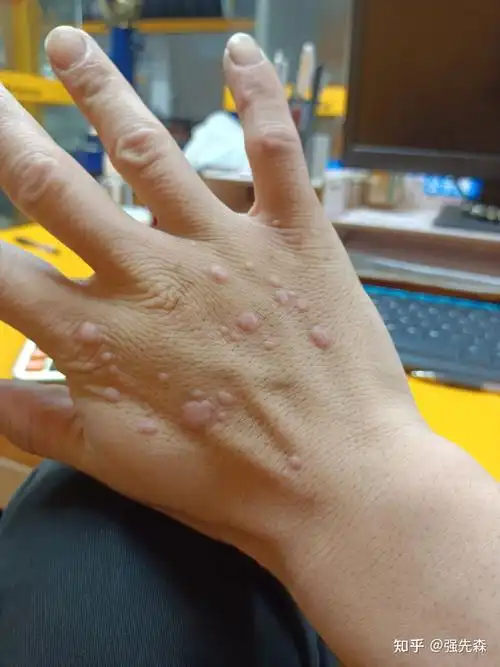 扁平疣在手上已经几年了,数量最近越来越多强先森